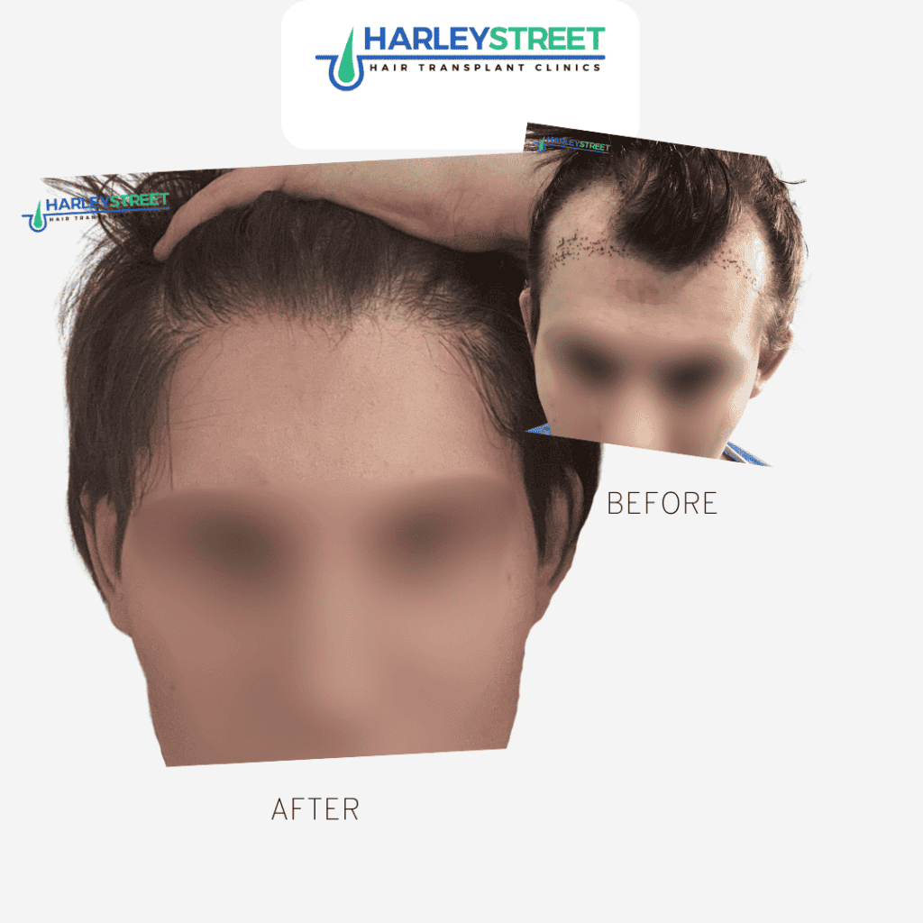 Charlotte trans - before and after