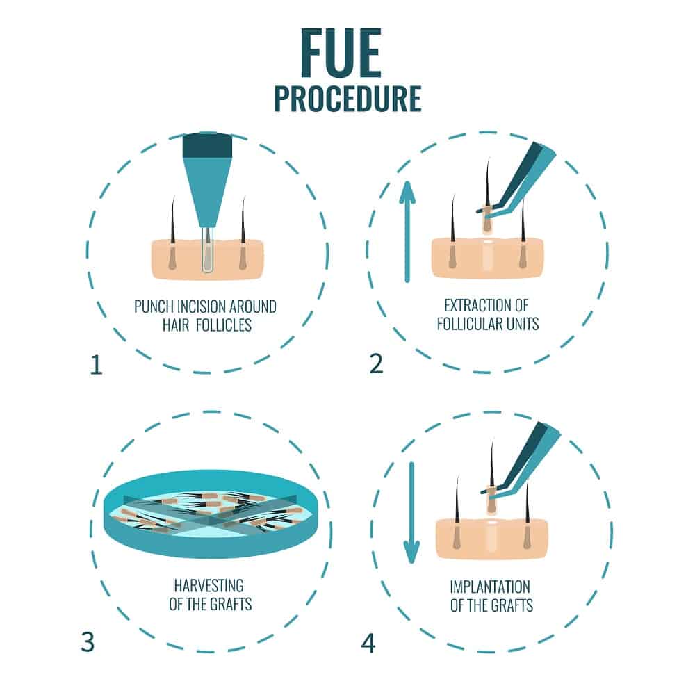 fue hair transplant method